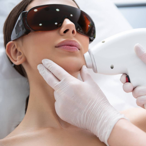 Chin Laser Hair Removal