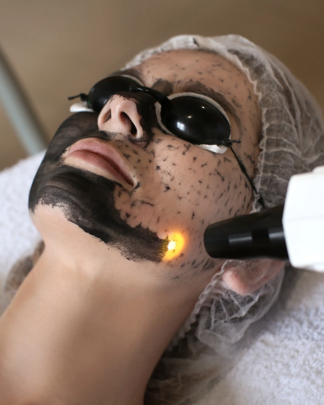 Carbon Peel Facial