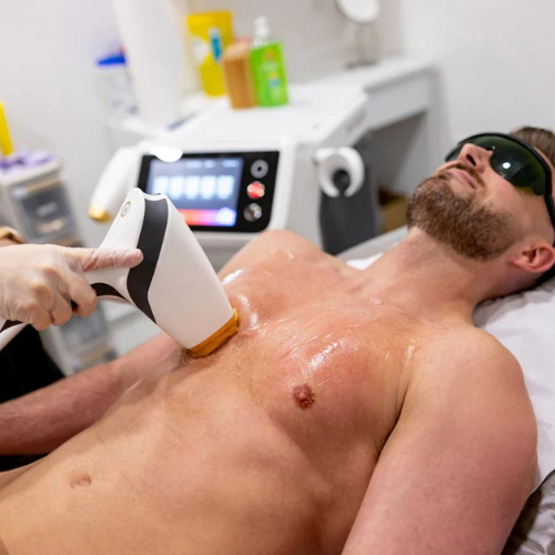Men's Chest or Stomach Laser Hair Removal