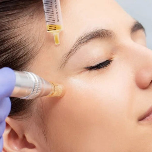 Micro Needling with PRP